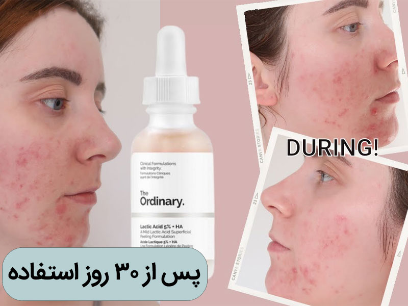سرم لاکتیک اسید 5 درصد اوردینری (1) سرم لاکتیک اسید %5 اوردینری
