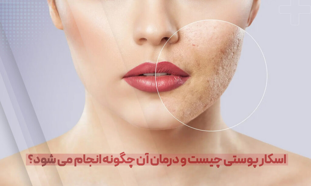 اسکار پوستی چیست