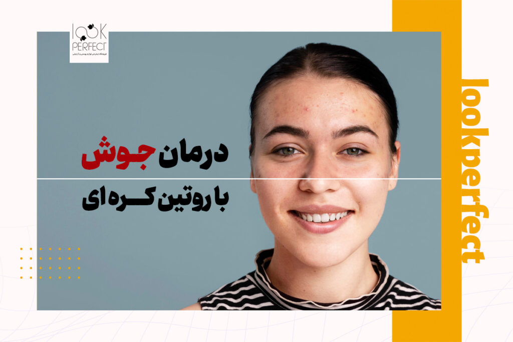 درمان جوش با روتین کره ای