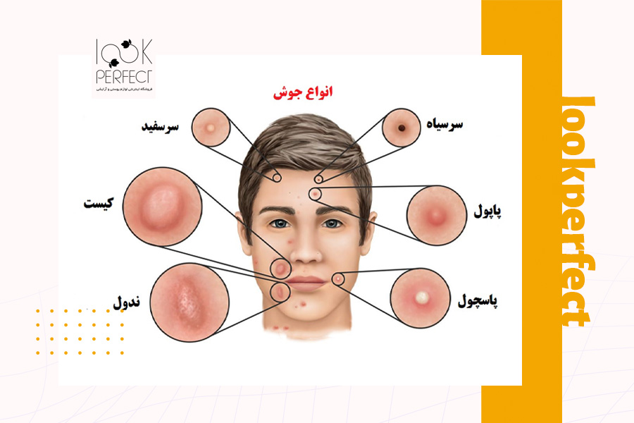نمودار گرافیکی انواع جوش، از جمله جوشهای سرسیاه، سرسفید، کیست، نودول، پاپول و پاسچول – شناسایی انواع آکنه