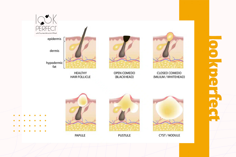 دیاگرام گرافیکی مراحل ایجاد جوش از منافذ باز تا جوشهای التهابی – درک روند شکلگیری آکنه