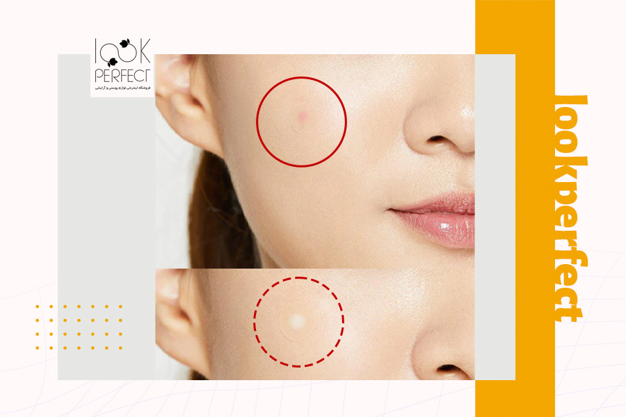 تصویر قبل و بعد از استفاده از پچ ضد جوش روی گونه؛ مرحله اول با جوش قرمز و مرحله دوم با جوش محو شده. مناسب برای نمایش تأثیر سریع محصولات ضد جوش