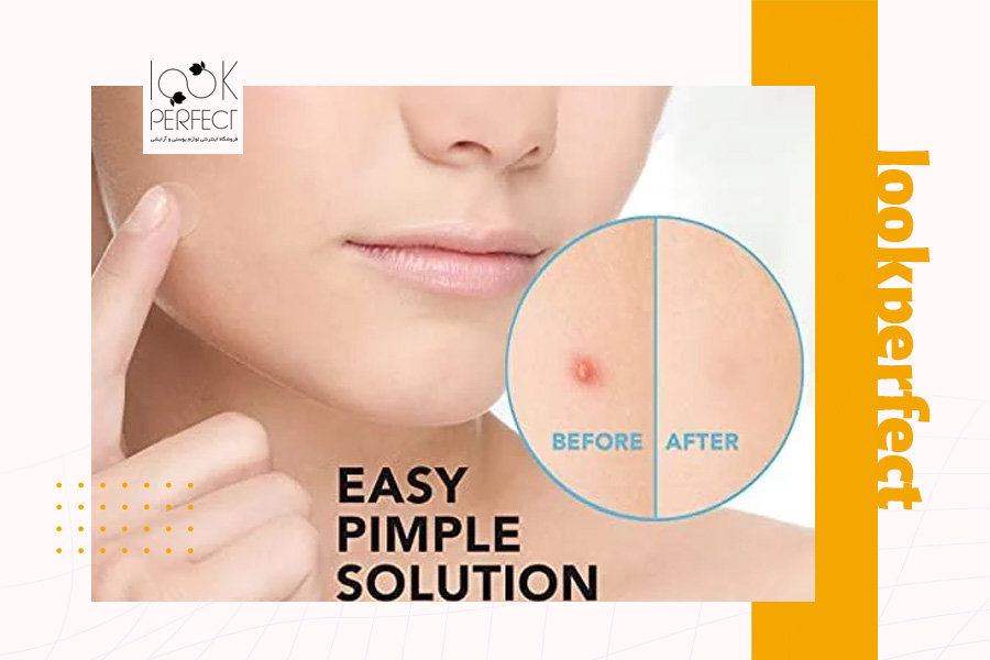 تصویر قبل و بعد از استفاده از پچ ضد جوش روی گونه؛ مرحله اول با جوش قرمز و مرحله دوم با جوش محو شده. مناسب برای نمایش تأثیر سریع محصولات ضد جوش