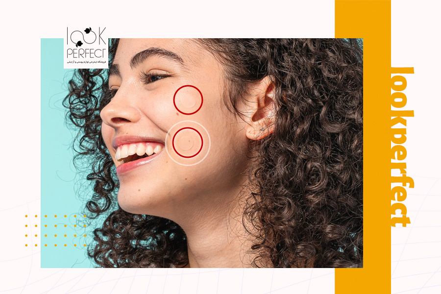 دختر جوان با لبخند و پوست سالم و شفاف، دو ناحیه روی گونه با دایرههای قرمز نشان داده شده که محل جوش قبلی و محو شده هستند؛ تصویری انرژیبخش از نتیجه درمان موفق.