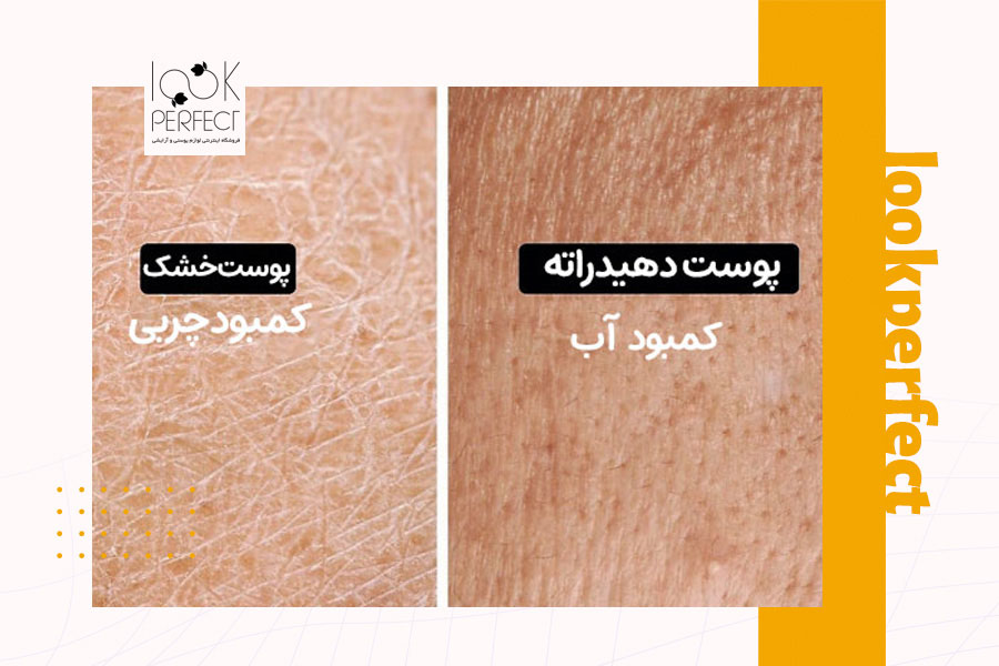 نمای نزدیک از پوست خشک با بافت خشن و سفیدک‌زده در مقایسه با پوست دهیدراته با بافت کم‌آب و بدون چربی