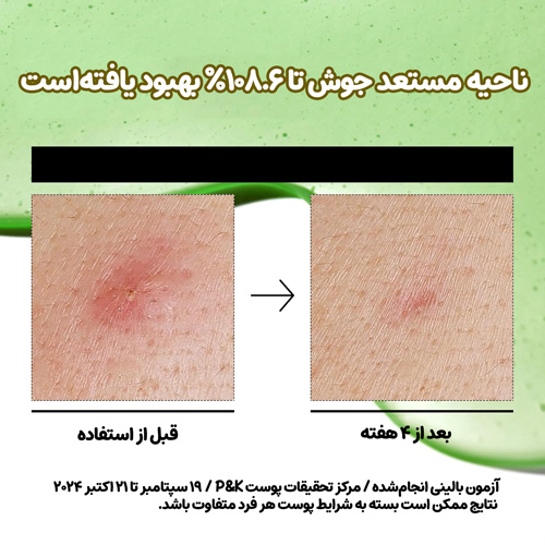 سرم تسکین دهنده آزلائیک اسید 10% و هیالورون آنوا (1) تصویر قبل و بعد از استفاده از سرم آزلائیک اسید آنوا روی ناحیه مستعد جوش، کاهش التهاب و قرمزی پوست پس از ۴ هفته