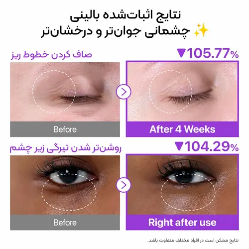 نتایج بالینی کرم دورچشم نامبوزین