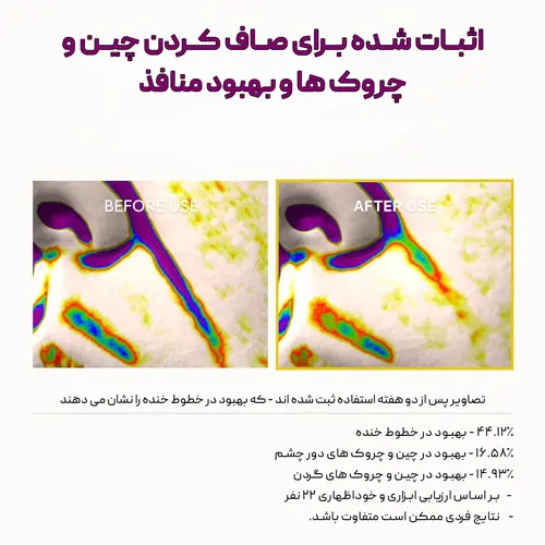 نتایج مستند و اثبات شده استفاده از کرم رتینول آرنسیا روی خطوط خنده و دور چشم