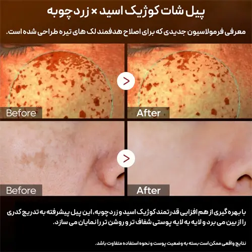 نتایج قبل و بعد استفاده از آمپول پیل شات برنج دکتر ملاکسین برای کاهش لک و تیرگی پوست