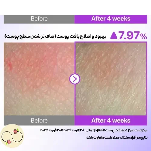 نتایج بالینی ضد افتاب نامبوزین شماره 9 پس از 4 هفته برای صاف شدن و بهبود بافت پوست