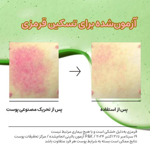 تست بالینی تأثیر سرم آزلائیک اسید و هیالورون آنوا روی قرمزی ناشی از تحریک مصنوعی پوست؛ قبل و بعد از استفاده